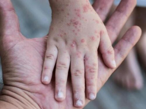 Vigilancia constante ante brote de coxsackie: SSa