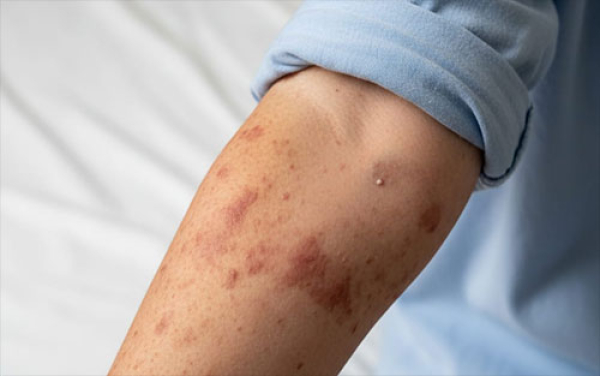 Secretar&iacute;a de Salud confirma primer caso de sarampi&oacute;n en Puebla